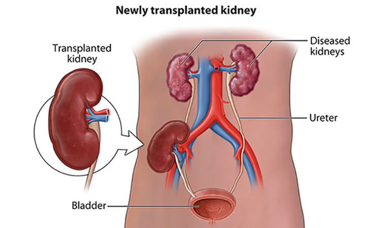  UPTH kidney Transplant center: on the horizon*